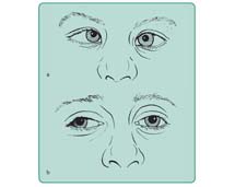 Zez oka prawego: a – zbieżny, b – rozbieżny